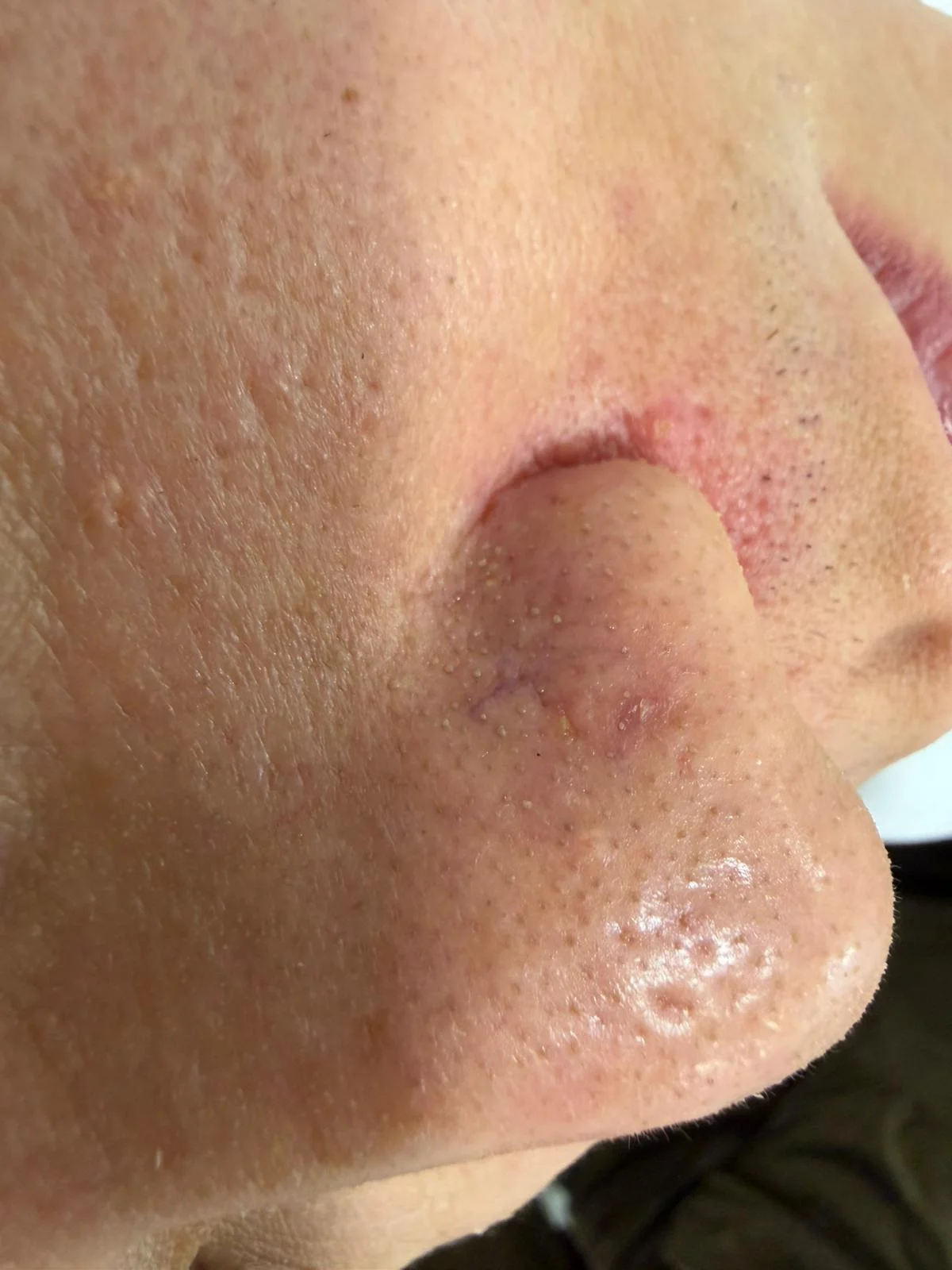 個別案例：方案後面頰暗瘡印狀況（示範相片，待換成已授權嘅真實相片）