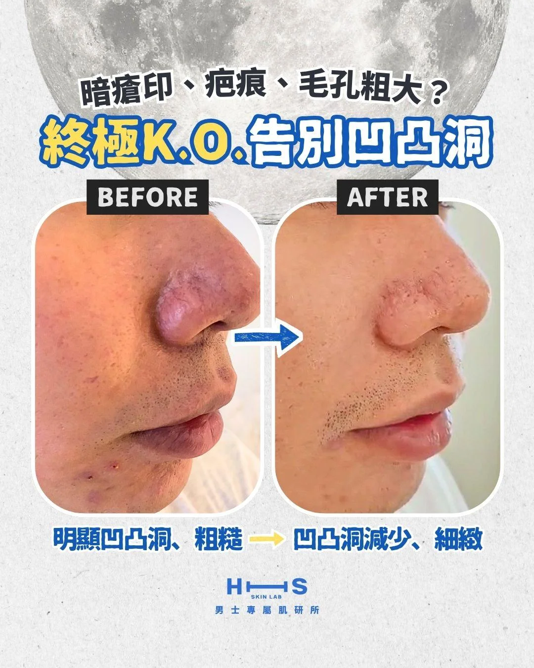 深層淨肌・控油護理 — 淨肌程序示意圖
