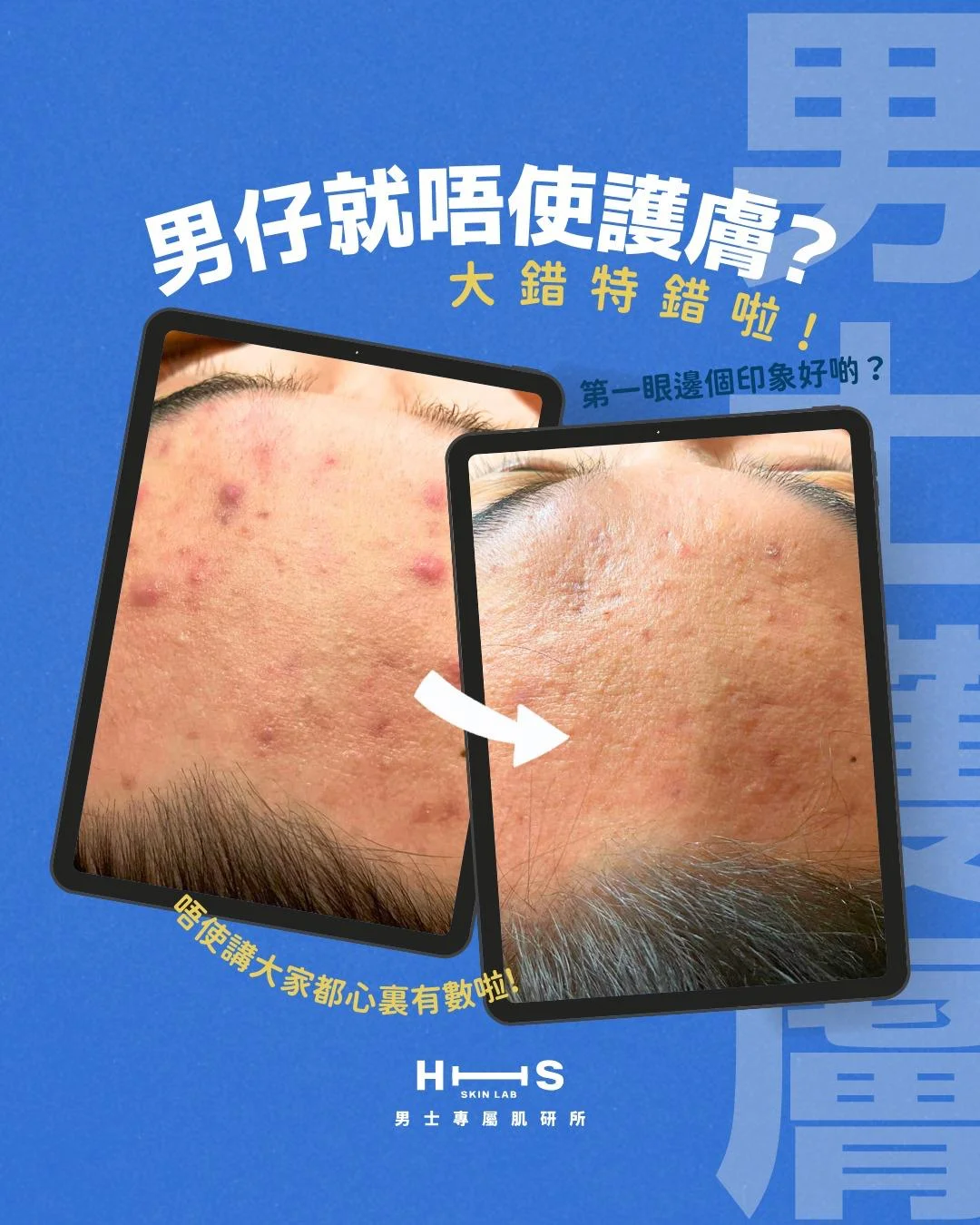 凹凸洞・毛孔重塑方案 — 疤痕類型分析示意圖